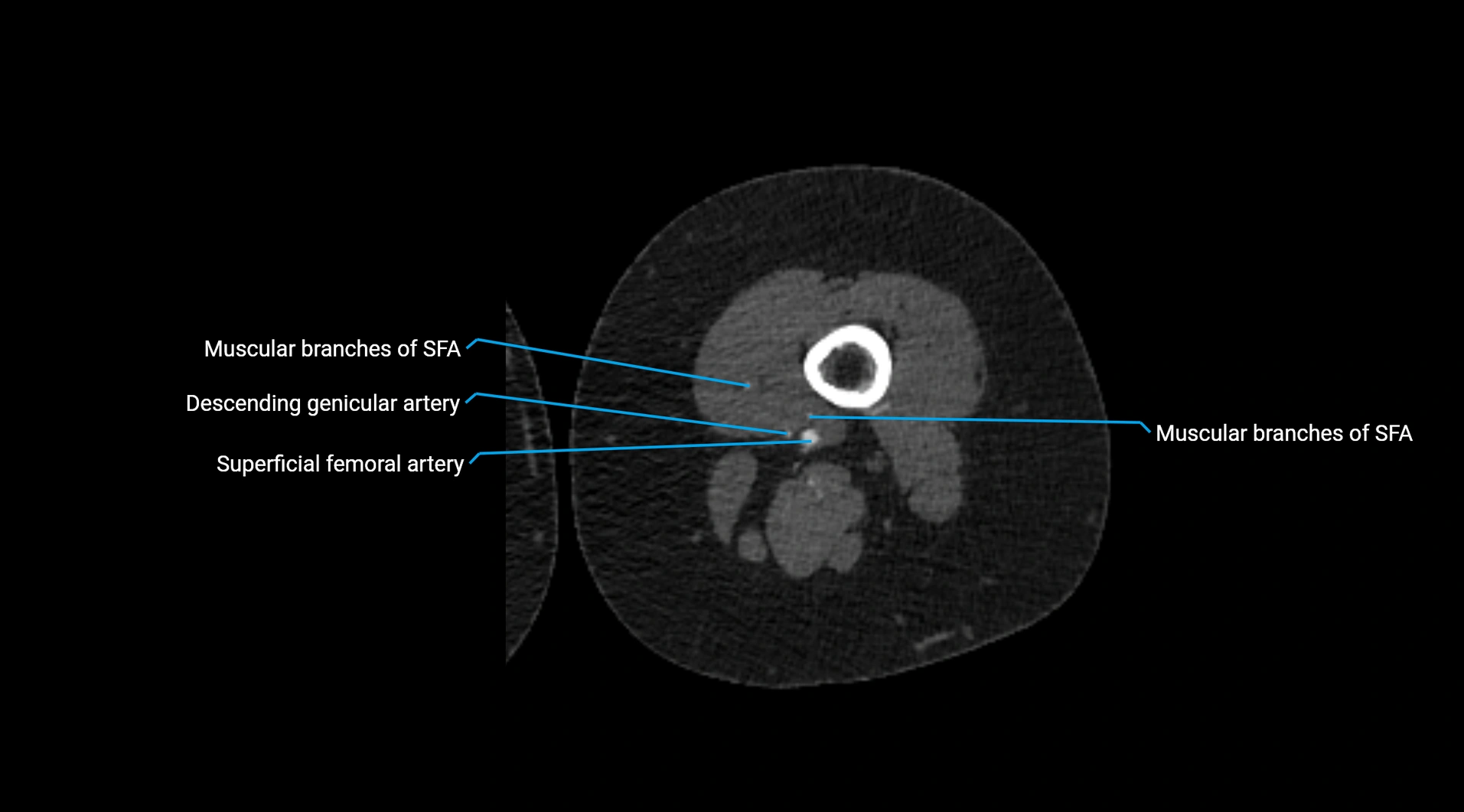 CTA lower limb cross sectional anatomy labelled image _148.webp
